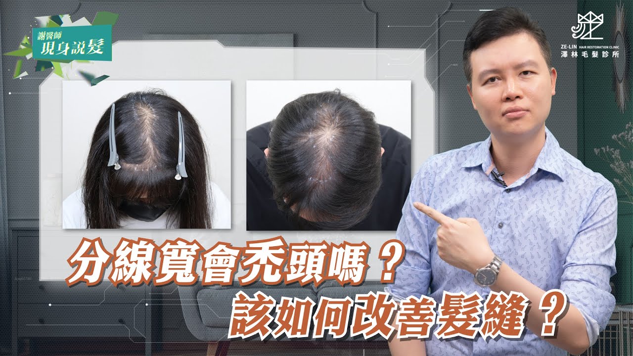 分線禿 髮縫稀疏該怎麼辦？改善方式大公開！｜澤林毛髮診所謝宗廷醫師