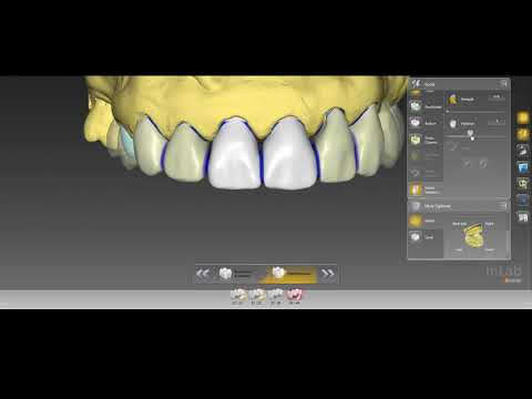 Digital Wax-up With Inlab 16
