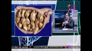 بالصور| استشاري جراحة عامة يكشف أسباب تكون 