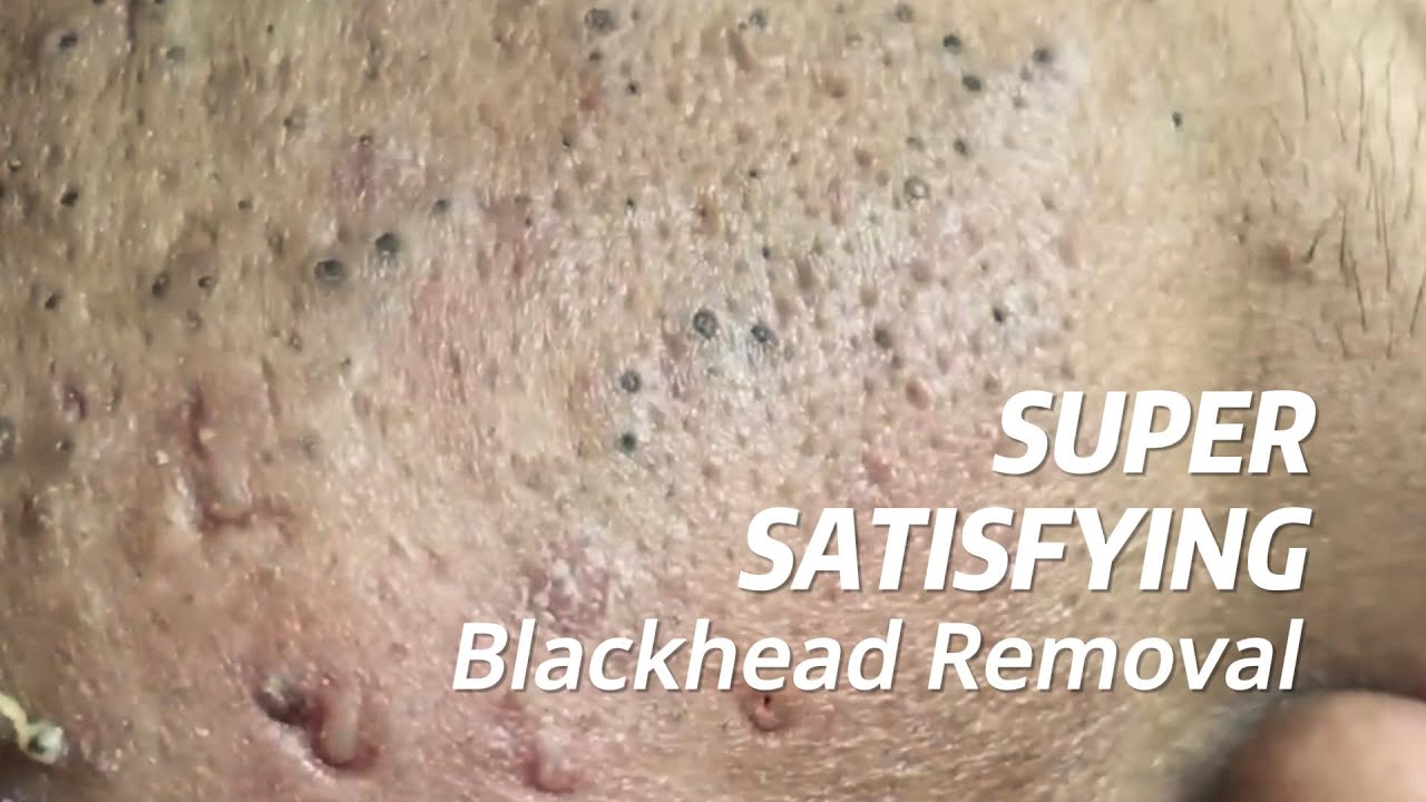 Super Satisfying BLACKHEAD REMOVAL - YouTube