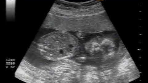 Första mötet  med Moa - ultraljud 12 feb 2003