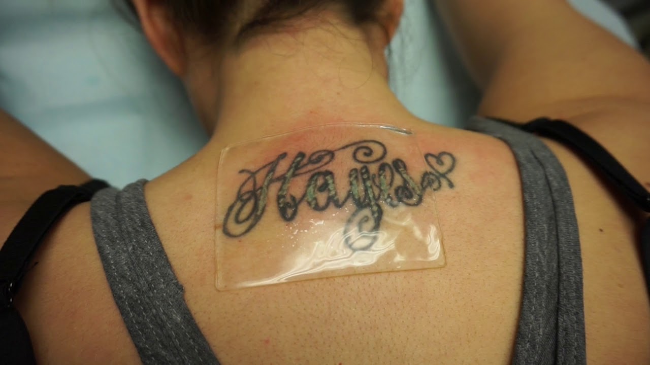 Laser Tattoo Removal | Queen of Lasers