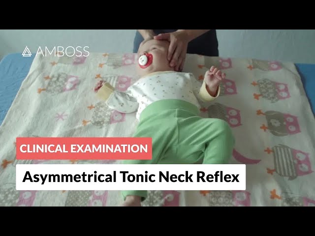 Asymmetrical Tonic Neck Reflex - Clinical Examination class=