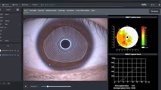 MediWorks Dry Eye Software-NIBUT Test Intro