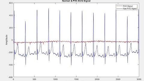 Premature Ventricular Contractions Detection using SVM & KNN Classifiers