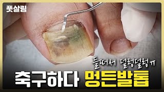 축구하다 피멍 든 발톱… 들뜨고 덜렁, 제거하고 싶어요.
