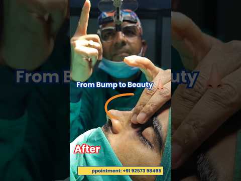drsuniltanvar Reshapes Nose Bump with EXPERT Rhinoplasty Skills by JaipurDoorbeen Hospital