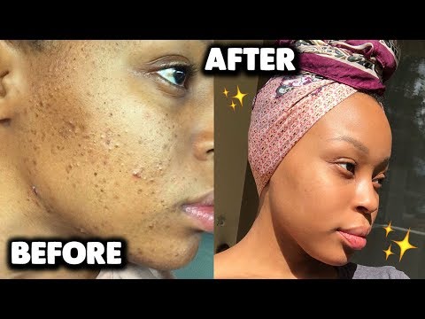 AFFORDABLE SKINCARE ROUTINE FOR ACNE & DARK MARKS/HYPERPIGMENTATION