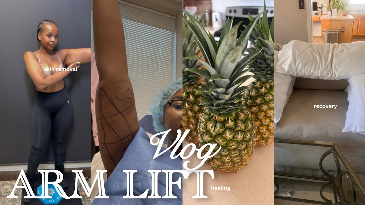 VLOG| Redoing My Arm Lift Surgery | Loose Skin After Weight Loss| The Good, The Bad & the Ugly!