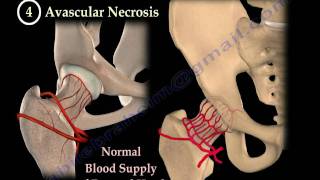 HIP PAIN ,COMMON CAUSES- Everything You Need To Know - Dr. Nabil Ebraheim