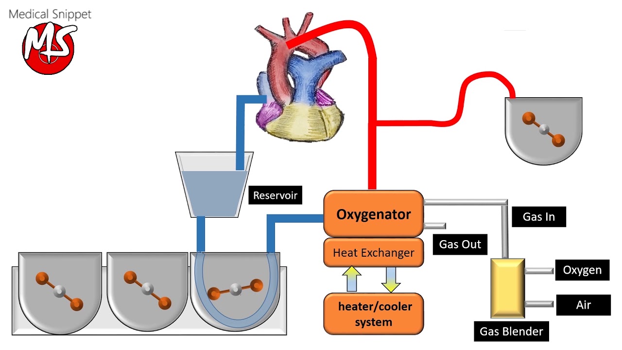 Cardiopulmonary Bypass  Cpb  Circuit