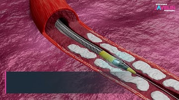 Shockwave Javelin Peripheral IVL Mechanism of Action (MOA) (International audience)