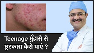 How To Get Rid Of Teenage Acne/Pimples (Teenage मुँहासे से छुटकारा कैसे पाएं) |(In HINDI)