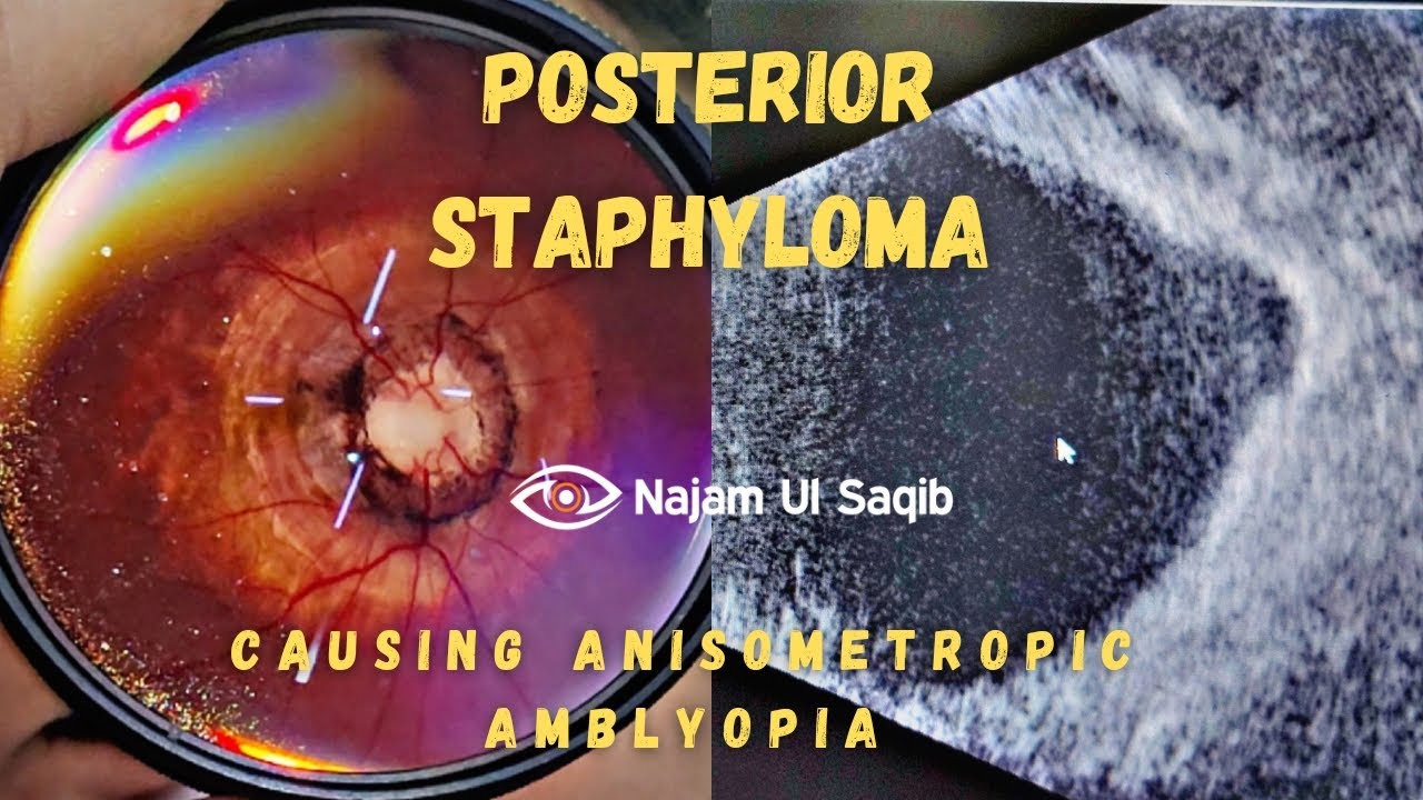 Posterior Staphyloma Causing Myopic Anisometropic Amblyopia YouTube