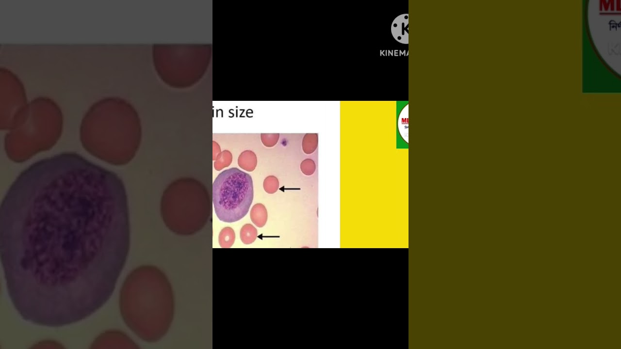 RBC Morphology Different Size, Shape and Abnormal Characters. 