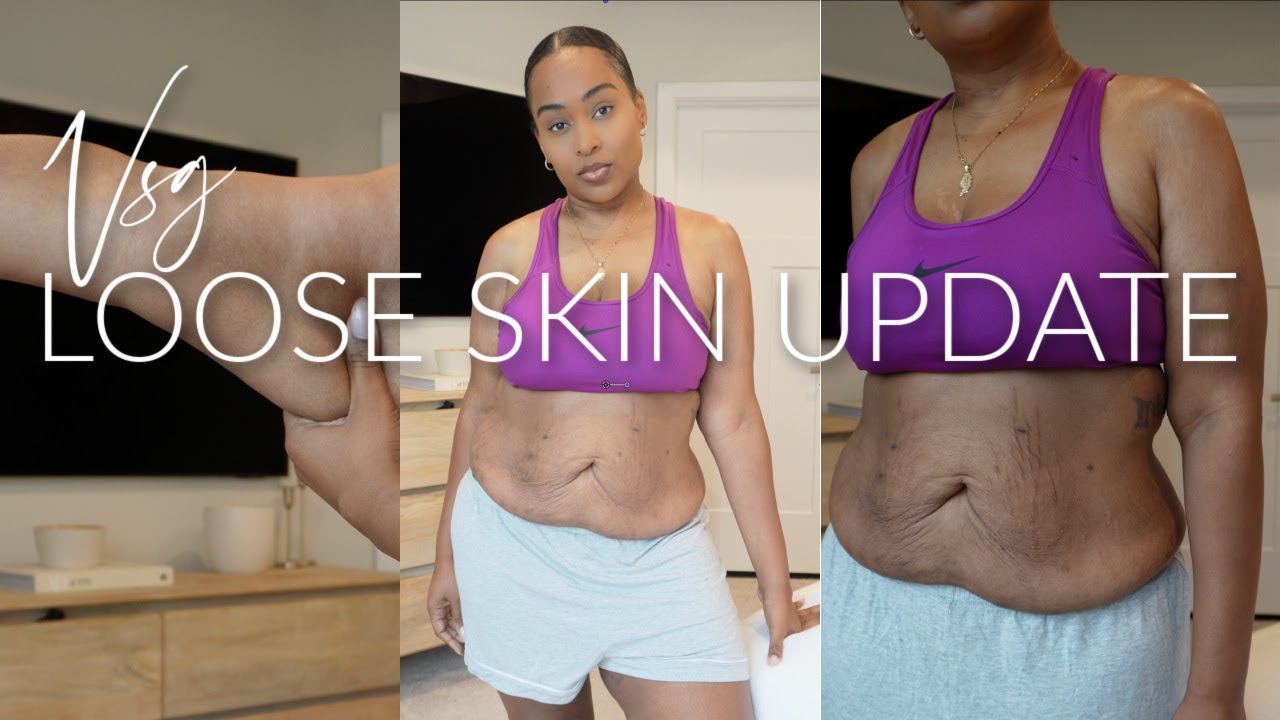 LOOSE SKIN AFTER VSG | SHOWING ALL OF MY LOOSE SKIN
