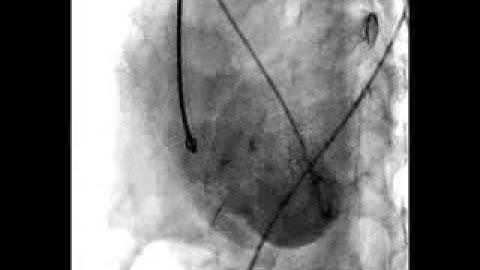 Device closure of ventricular septum rupture after myocardial infarction