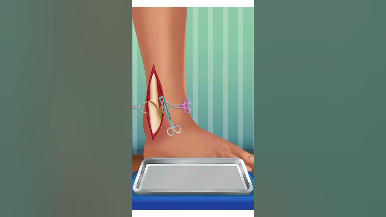 leg bones surgerysurgery animation videoMedicine animationleg break
