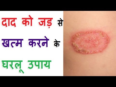 दाद को जड़ से खत्म करने के उपाय || Daad Ke Gharelu Ilaj || Ringworm Home Remedy