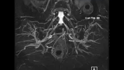 Normal MR Neurography Lumbosacral Plexus