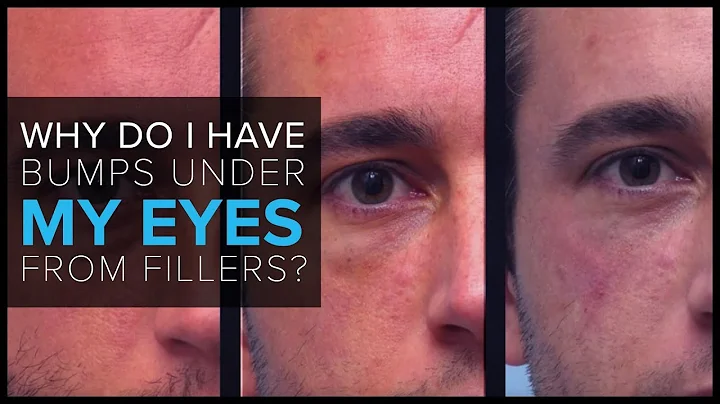 FAQ: “Why do I have bumps under my eyes after receiving fillers?”