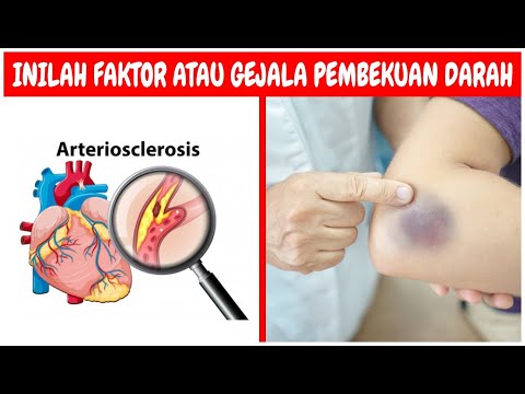 KESEHATAN : Inilah Faktor atau Gejala Penyebab Pembekuan Darah (Hemostasis)