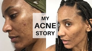 My Acne Story