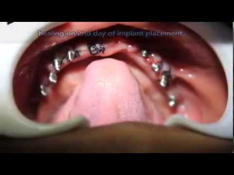 Multiple tooth extraction and immediate implants in INDIA - YouTube