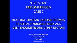 LIVESCAN 7 ENDOMETRIOSIS screenshot 1