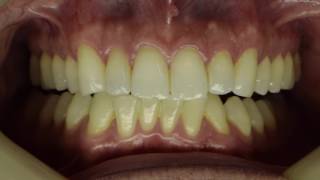 Comparing occlusion to an articulator