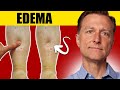 8 surprising causes of edema uncover the truth