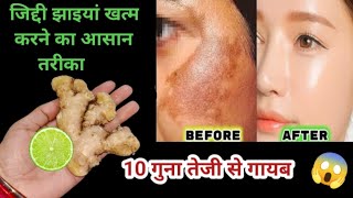 अदरक से झाइयां हटाने का कमाल का तरीका | Reduce Melasma, Pigmentation, Discolouration, Blackspots screenshot 3