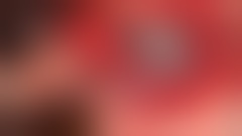 Dissection on Sylvian Fissure case 2