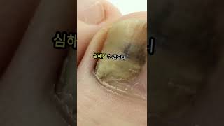 여름철 손발톱 이렇게 관리하세요, 손톱 눌림과 발톱 변형까지 예방하는 생활팁 #손발톱위생 #어르신건강 #건강이최고야