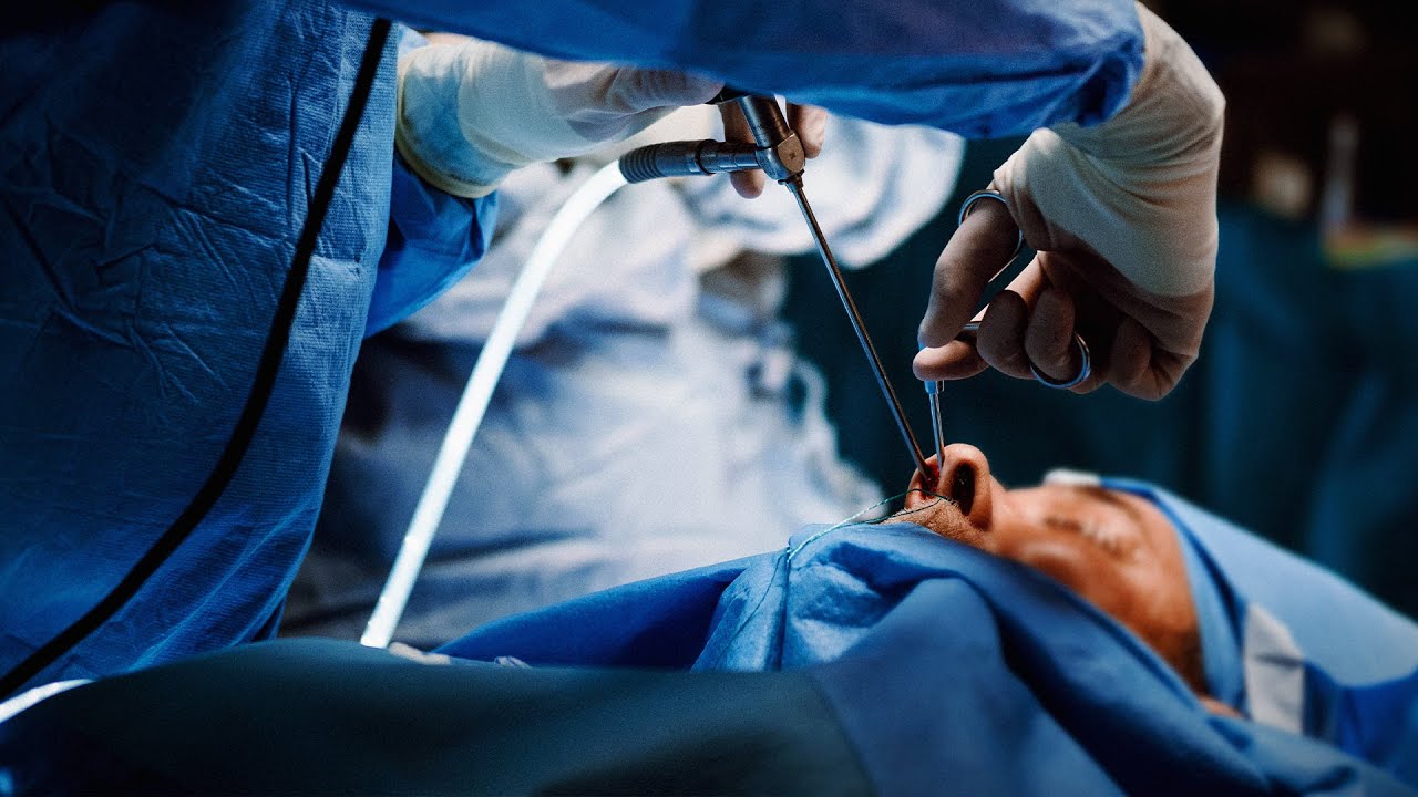 Bilateral Endoscopic Sinus Surgery for Chronic Rhinosinusitis by Erin K