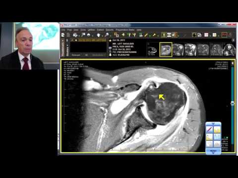 Arthrogram Versus. MRI for Rotator Cuff