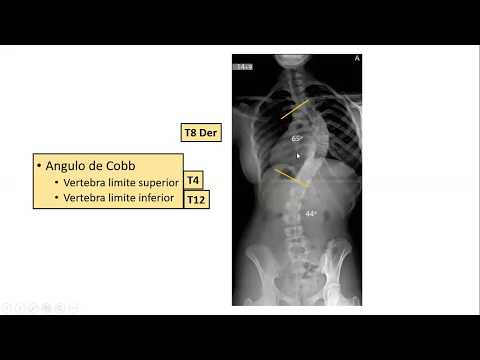 Escoliosis idiopática del adolescente Dr Juan Guevara