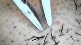 毛 抜く 血 Youtube