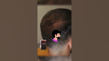 Thumbnail of 🔍 Find Caboki Hair Fiber Near Me   Instant Fix! 💼  #hairbuildingfibres #barbershop #hairlinelowering