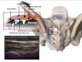 ULTRASOUND SACROILIAC JOINT INFILTRATION