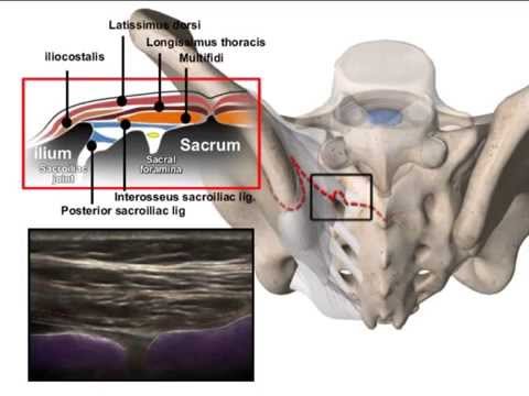 Sacroiliac joint steroid injection video