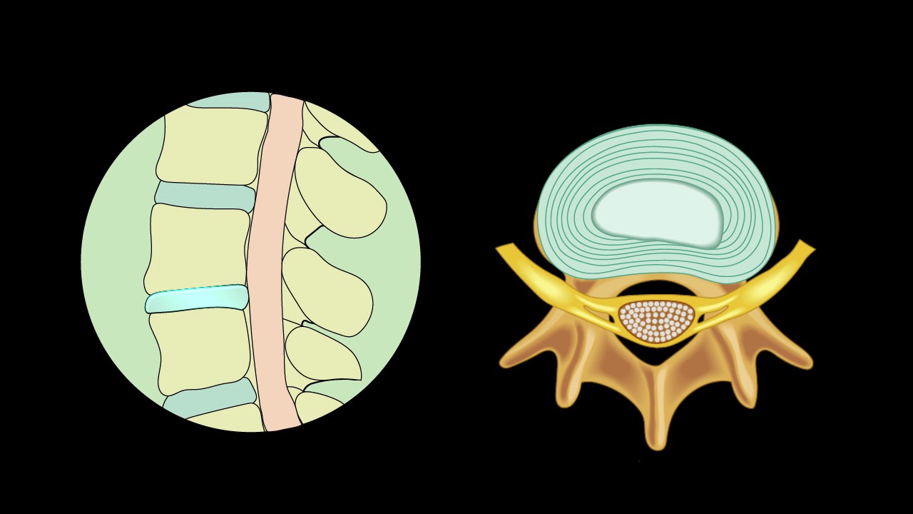 Herniated Disc YouTube