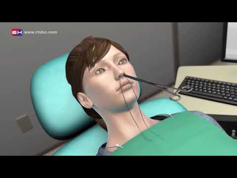 Video: Etmoidni Sinusitis: Uzroci, Simptomi I Dijagnoza