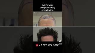 Before and After FUE Hair Transplant results Natural looking hairline #fue #hair #fuehairrestoration