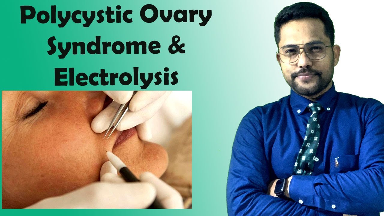 Polycystic Ovary Syndrome Electrolysis, HOW TO REMOVE FACIAL HAIR PERMANENTLY YouTube