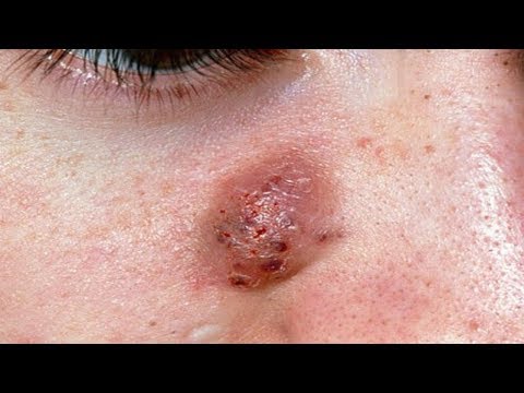 Acne Types, Best Treatments, Cystic Acne Part  | Good skin care