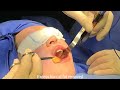 Featured Surgery - Buccal Fat Excision #BuccalFatSurgery