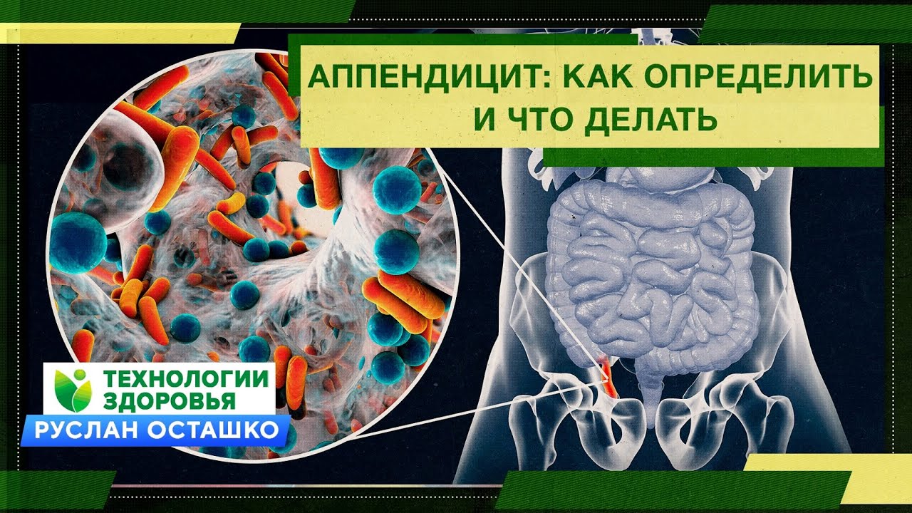 Аппендицит: как определить и что делать (Руслан Осташко) - YouTube