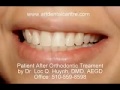 A journey to a beautiful smile with braces by dr loc huynh dmd