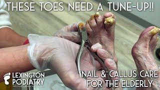 These Toes Need A Tune-up!! Nail &amp; Callus Care for the Elderly